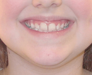 Bandeen Orthodontics Case Studies Frankel