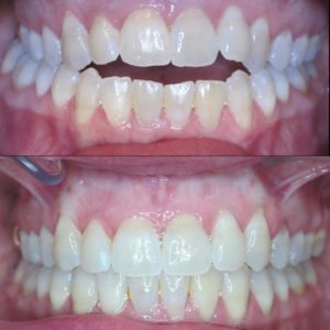 Bandeen Orthodontics Case Studies Open Bite