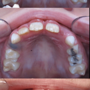 Bandeen Orthodontics Case Studies Crossbite