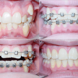 Bandeen Orthodontics Case Studies Extractions