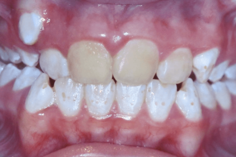 Case Study 59 – Brown Stains on Teeth