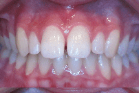 Case Study 60 – Length of teeth and “gummy” smile