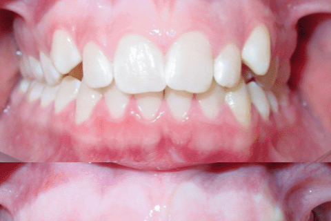 Case Study 62 – Gummy smile
