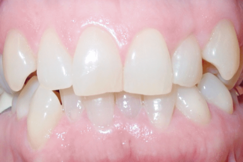 Case Study 64 – Worn edges of front teeth restored