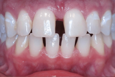 Case Study 67 – Spaces between teeth