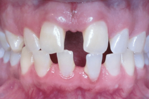Case Study 68 – Spaces between teeth (Invisalign)