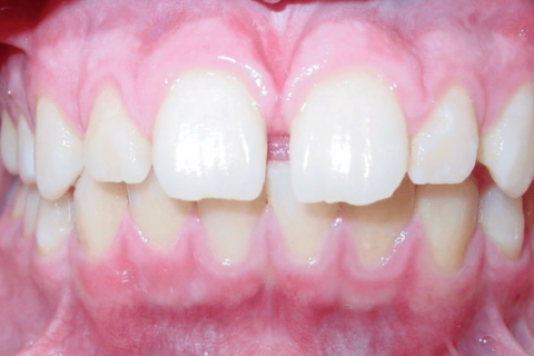Case Study 69 – Spaces between upper front teeth (Invisalign)