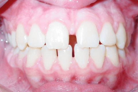 Case Study 70 – Spaces between teeth