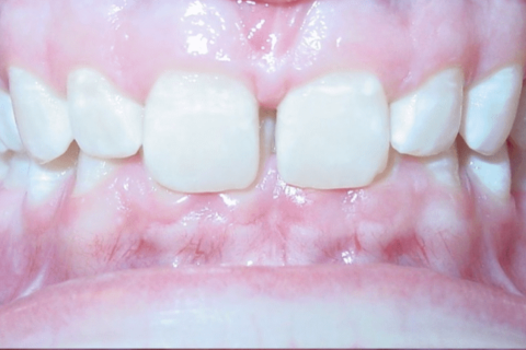 Case Study 71 – Spaces between teeth