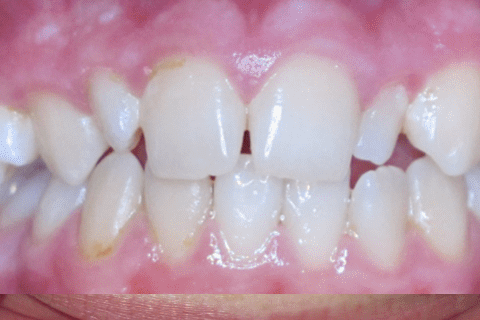 Case Study 50 – Premolar in the roof of the mouth