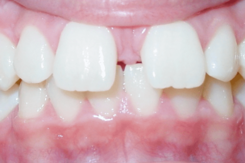 Case Study 73 – Second premolars impacted due to early loss of baby teeth