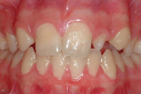 Case Study 77 – Missing upper right lateral incisor, peg upper left lateral incisor, and replaced both with dental implants