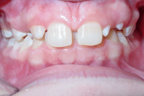 Case Study 78 – Missing upper right lateral incisor, peg upper left lateral incisor, and camouflaged the absence of both with moving the other teeth forward