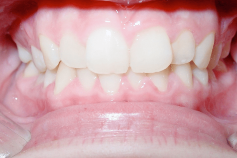 Case Study 81 – Missing lower second premolars, and camouflaged the absence of both with moving the other teeth forward