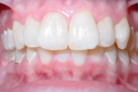 Case Study 84 – Missing a lower right first molar, and camouflaged the absence of both with moving the other teeth forward