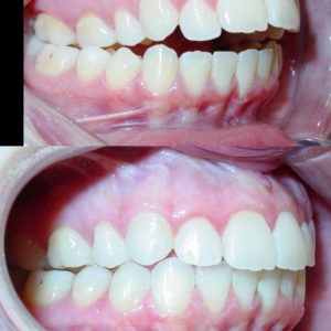 Bandeen Orthodontics Case Studies Open Bite