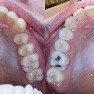 Bandeen Orthodontics Case Studies Narrow Smiles