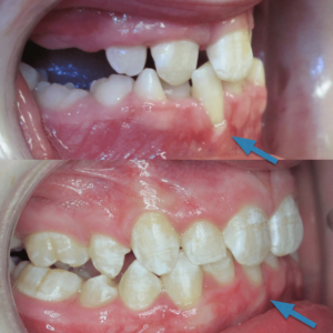 Bandeen Orthodontics Case Studies Crossbite