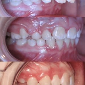 Bandeen Orthodontics Case Studies Frankel
