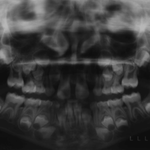 Bandeen Orthodontics Case Studies Crowding