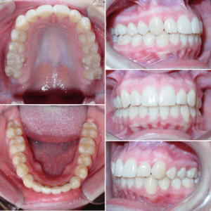 Bandeen Orthodontics Case Studies Narrow Smiles
