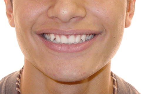 Case Study 4 – Orthodontic Class II