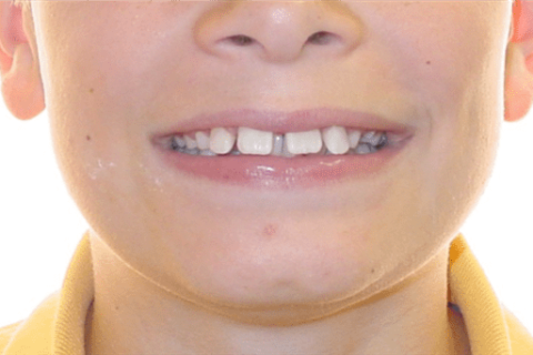 Case Study 6 – Orthodontic Class II