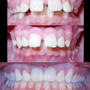 Bandeen Orthodontic Case Studies Class II