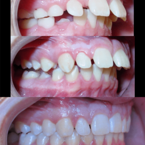 Bandeen Orthodontic Case Studies Class II