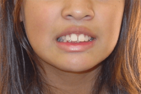 Case Study 2 – Orthodontic Class II