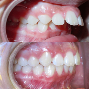 Bandeen Orthodontics Case Studies Class II