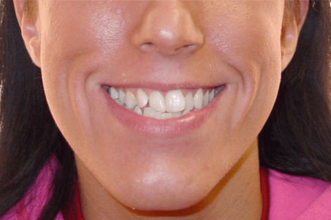 Case Study 12 – Orthodontic Class III