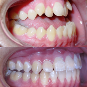 Bandeen Orthodontics Case Studies Class III