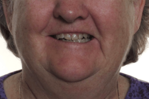 Case Study 10 – Orthodontic Class III