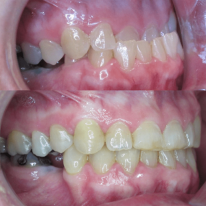 Bandeen Orthodontics Case Studies Class III