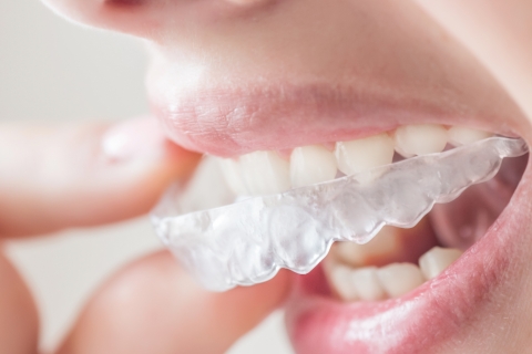 Should you Consider Invisalign for your Orthodontic Treatment?