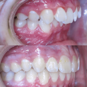 Bandeen Orthodontics Case Studies Class II