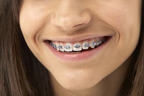 Getting Braces? Here’s How You Can Take Care of Your Teeth During Your Orthodontic Treatment